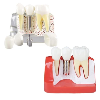 Демонстрационен модел на зъби, импланти, свалящ се коронката за анализ, мостовидный протеза за комуникация с пациента